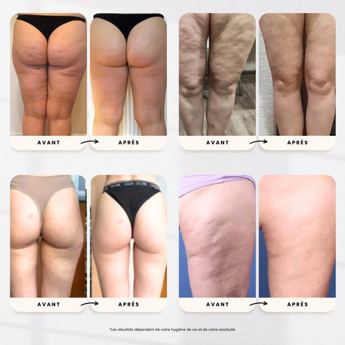 Masseur Anti-Cellulite LUNEYA